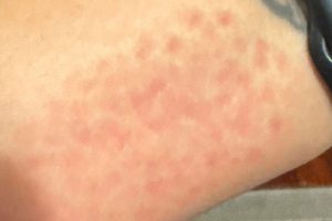close up of makeup mimicking measle rash