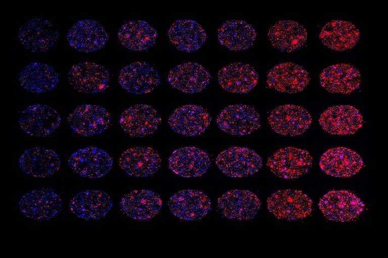 Image shows patient tumor cell growth in Encapsulate's Biochip System